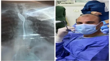 استخراج ملعقة من بطن مسنة في 7 دقائق ينقذ حياتها في مستشفى شبين الكوم 1